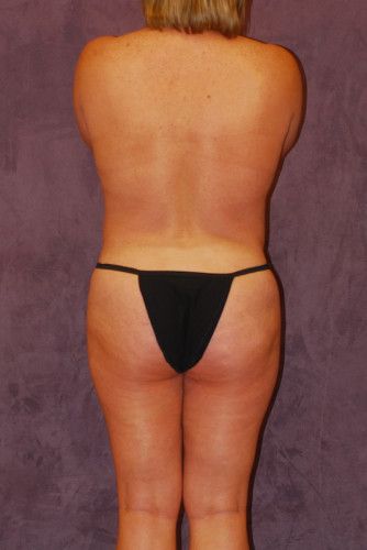 Brazilian Butt Lift Before & After