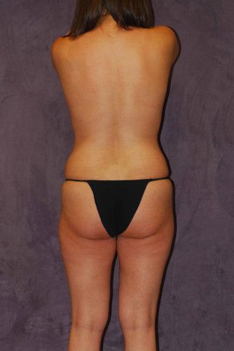 Brazilian Butt Lift Before & After