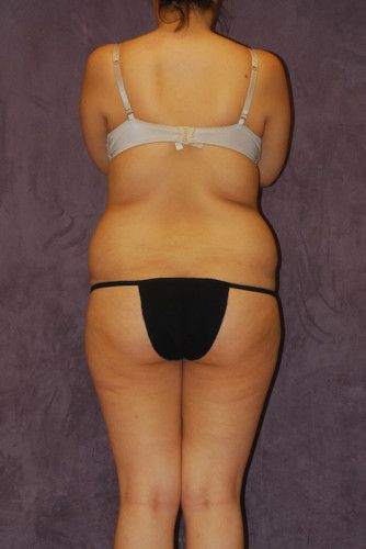 Brazilian Butt Lift Before & After