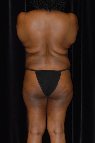 Brazilian Butt Lift Before & After