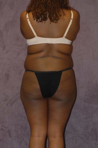 Brazilian Butt Lift Before & After