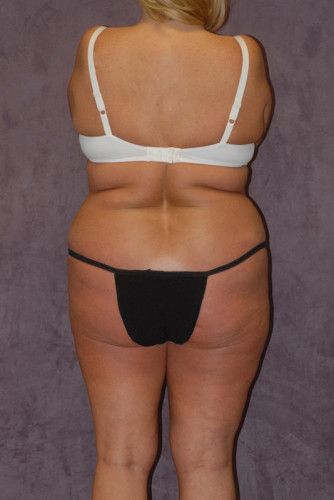 Brazilian Butt Lift Before & After