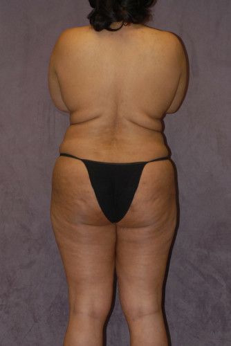 Brazilian Butt Lift Before & After