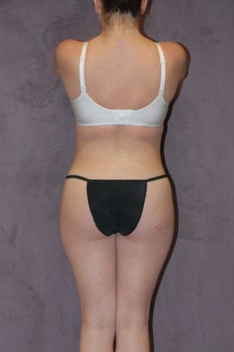 Brazilian Butt Lift Before & After