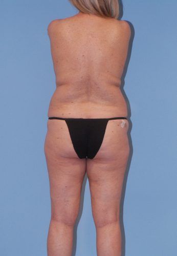 Brazilian Butt Lift Before & After