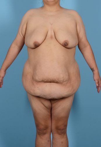 Brazilian Butt Lift Before & After