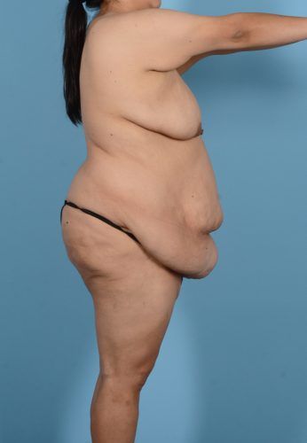 Brazilian Butt Lift Before & After