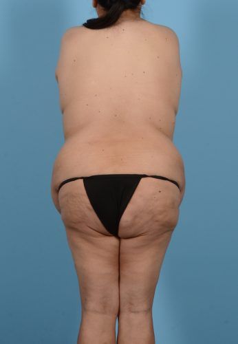 Brazilian Butt Lift Before & After