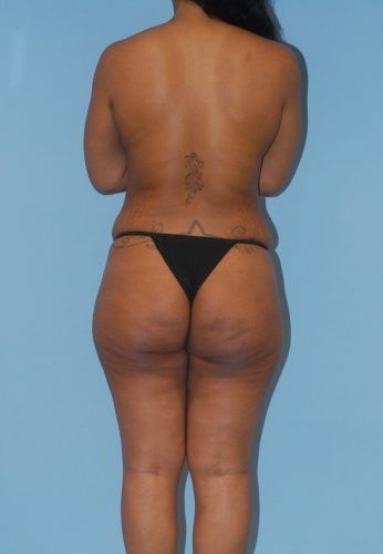 Brazilian Butt Lift Before & After