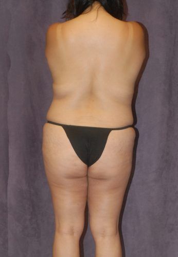 Brazilian Butt Lift Before & After