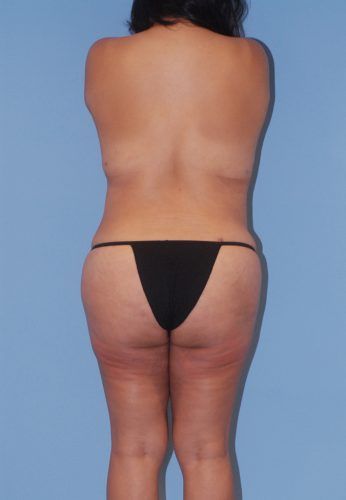Brazilian Butt Lift Before & After