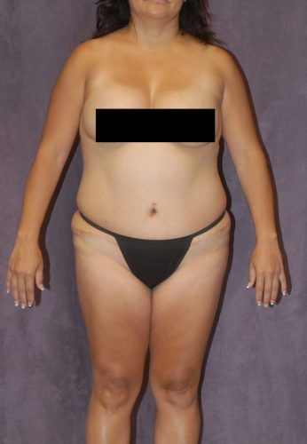 Brazilian Butt Lift Before & After
