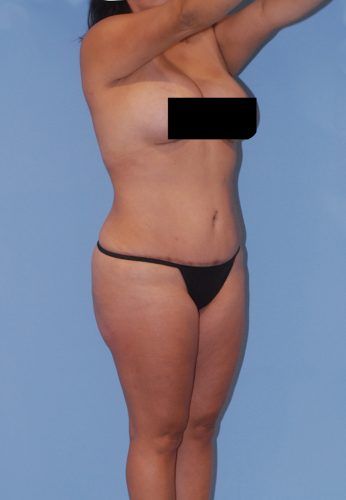 Brazilian Butt Lift Before & After