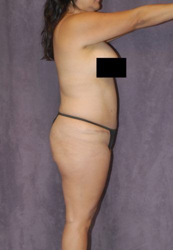Brazilian Butt Lift Before & After