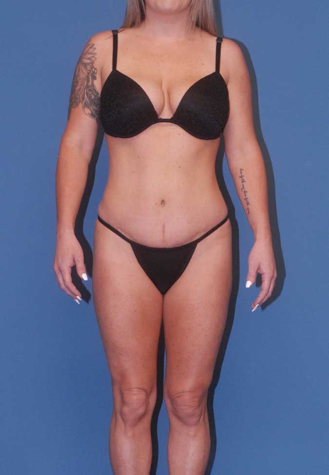 Brazilian Butt Lift Before & After