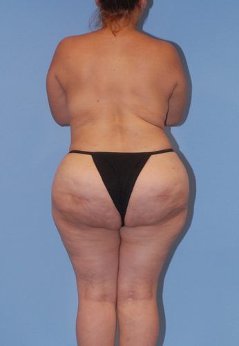 Brazilian Butt Lift Before & After