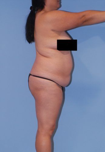 Brazilian Butt Lift Before & After