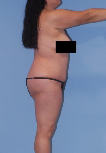 Brazilian Butt Lift Before & After