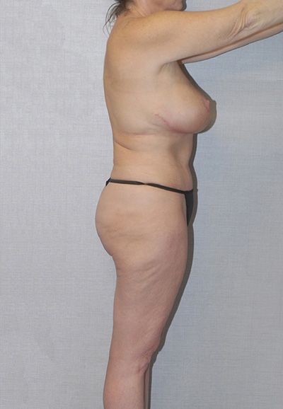 Brazilian Butt Lift Before & After