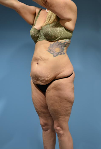 Torsoplasty Before & After