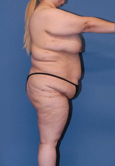 Torsoplasty Before & After