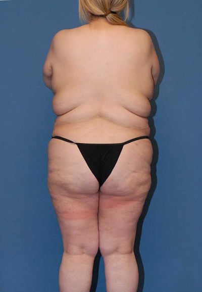 Torsoplasty Before & After