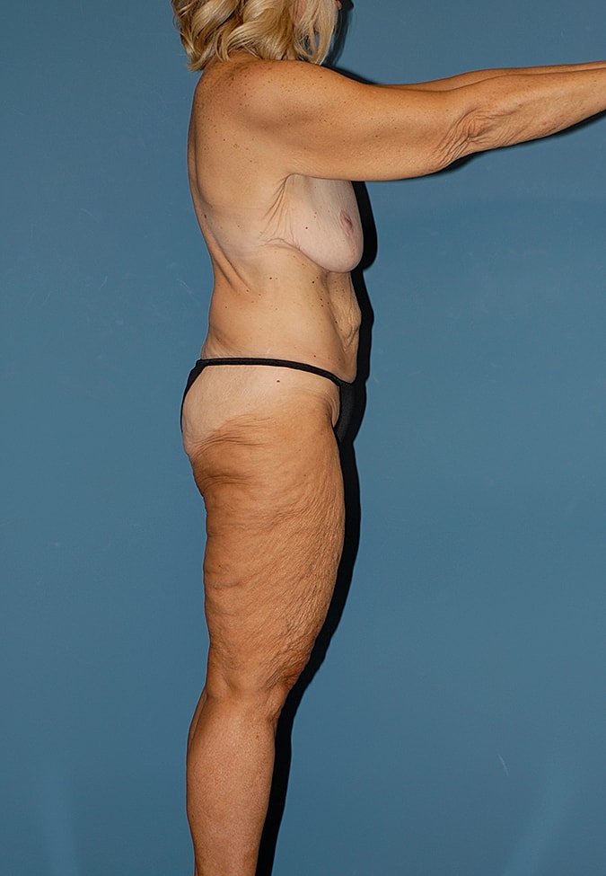 Torsoplasty Before & After