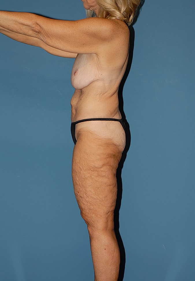 Torsoplasty Before & After