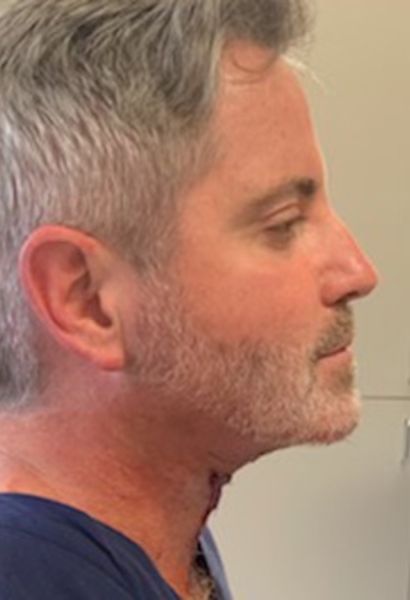 Tz Plasty Before & After