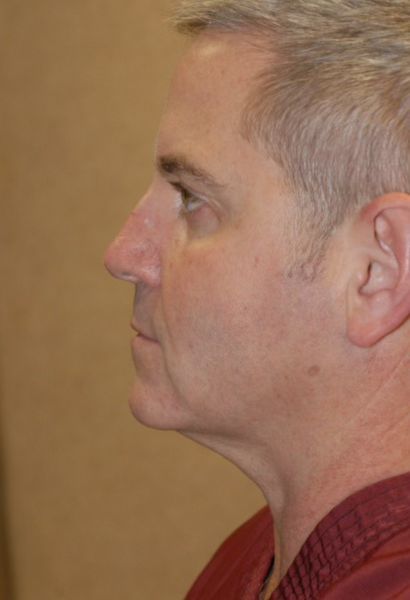 Tz Plasty Before & After