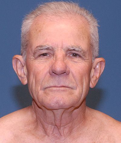 Tz Plasty Before & After