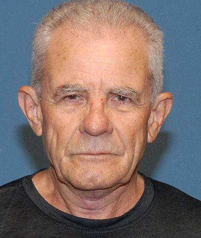 Tz Plasty Before & After