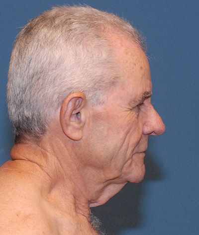 Tz Plasty Before & After