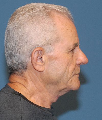 Tz Plasty Before & After