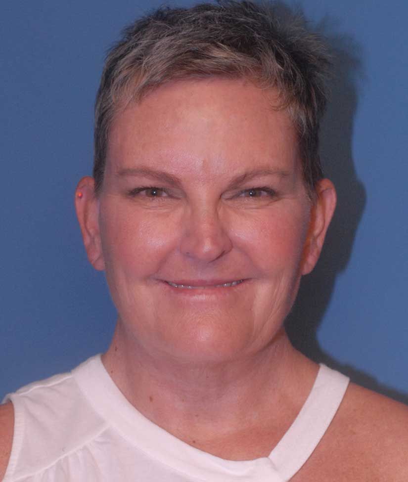 Face Resurfacing Before & After