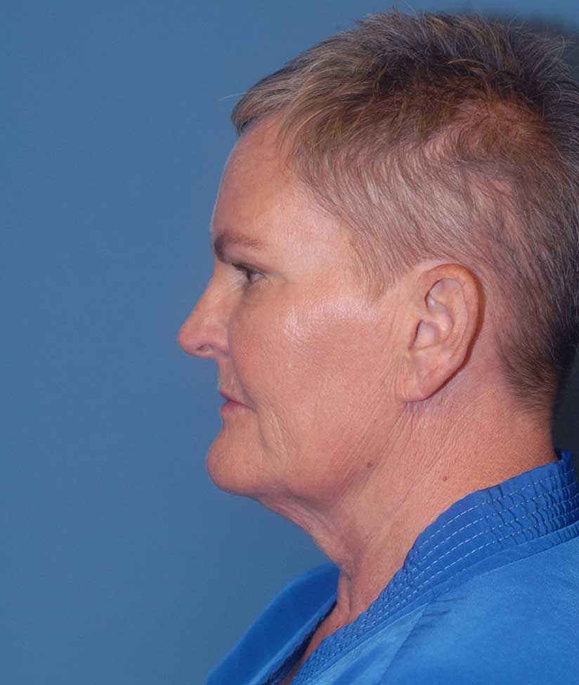 Face Resurfacing Before & After