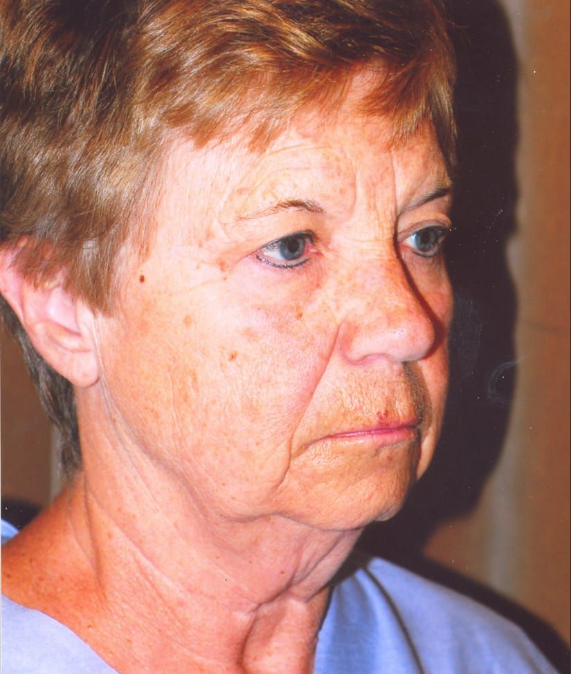 Face Resurfacing Before & After