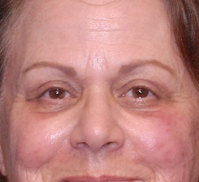 Face Resurfacing Before & After