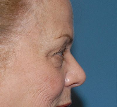 Face Resurfacing Before & After