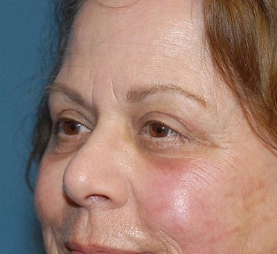 Face Resurfacing Before & After