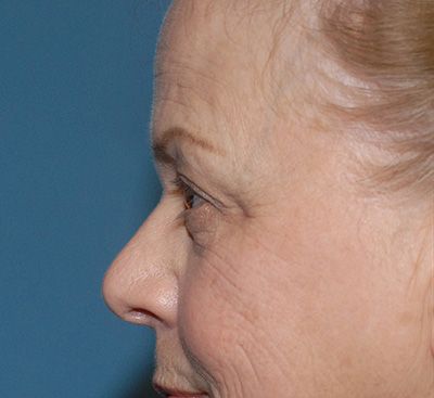 Face Resurfacing Before & After