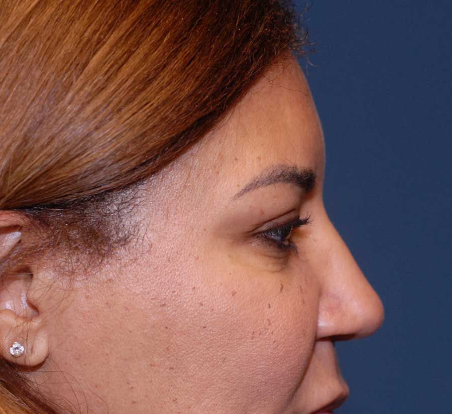 Blepharoplasty Before & After