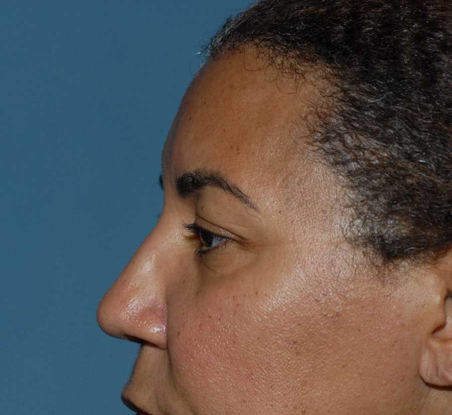 Blepharoplasty Before & After