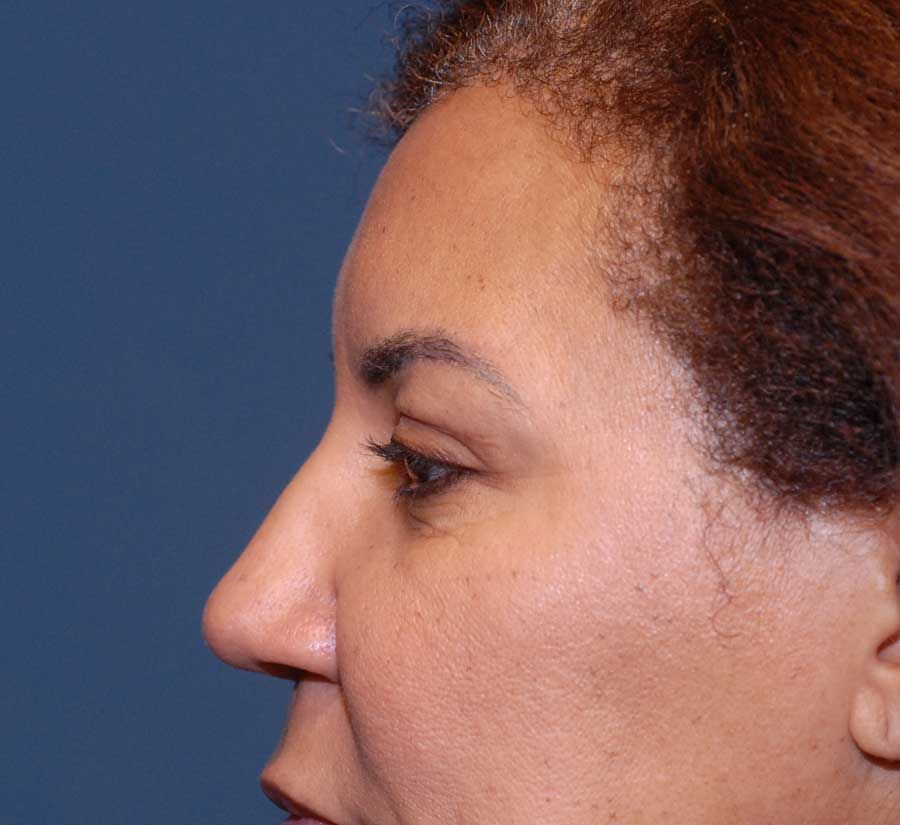 Blepharoplasty Before & After