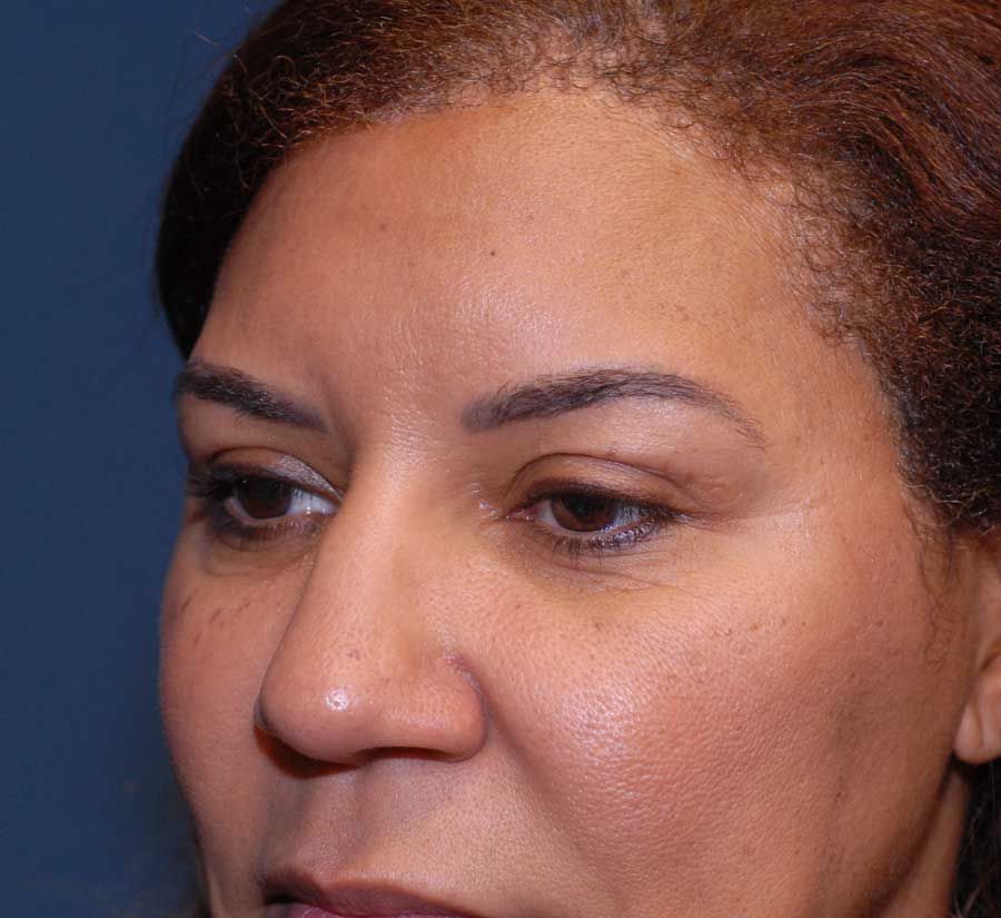 Blepharoplasty Before & After