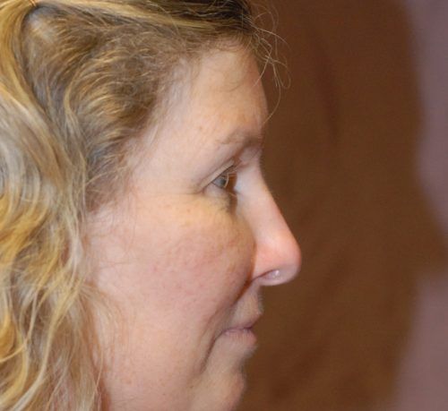 Blepharoplasty Before & After