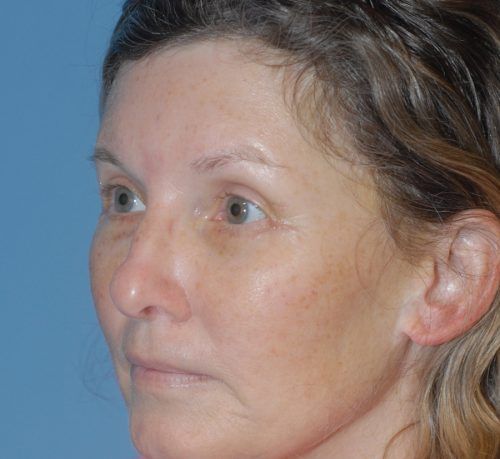 Blepharoplasty Before & After