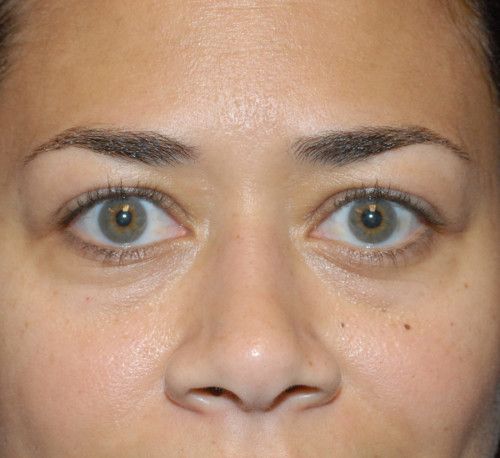 Blepharoplasty Before & After