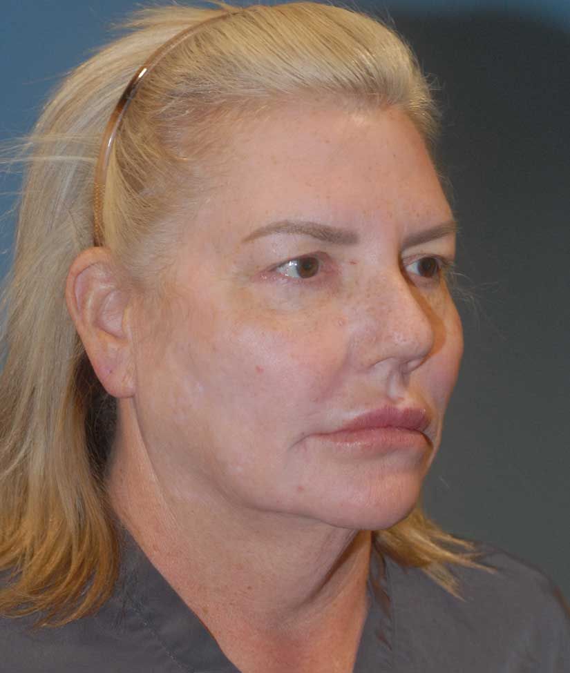 Blepharoplasty Before & After