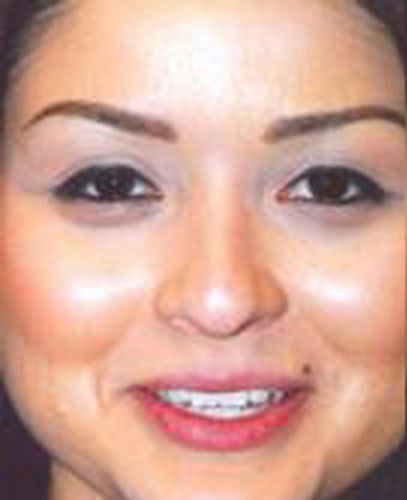 Blepharoplasty Before & After